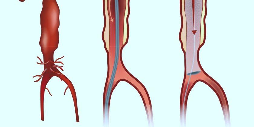 Aneurisma de aorta